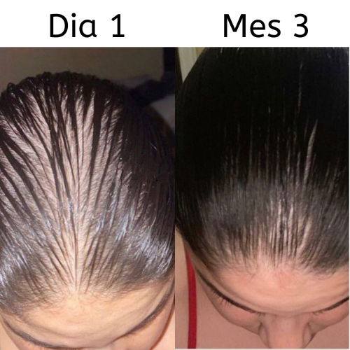 Kavelia™ Premium Minoxidil 5% + Keratina